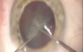 Counter Chopping Technique for Microincision Cataract Surgery (MICS)