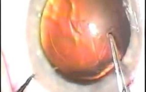 Capsulorrhexis Centration Technique