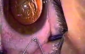 Chang Hydrodissection Cannula
