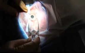 Chu Femto Speculum