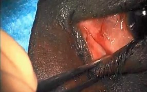 DCR Intubation Stent Procedure