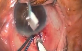 Fechtner EX-PRESS Marker for Glaucoma Surgery 