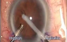 Fukasaku HydroChop Cannula