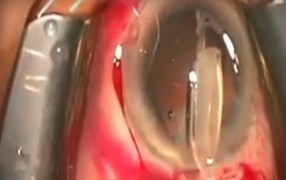 The B H Kim Intraocular Mirror