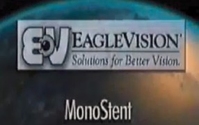 MonoStent Procedure from EagleVision