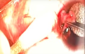 Pterygium Removal Technique Using Ambiodry2