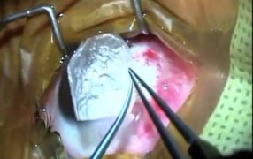 Pterygium Surgery with Adhesive Free, Amniotic Membrane