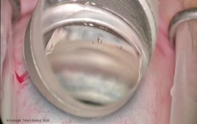 Arsham Sheybani Demonstrates His iStent MIGS Technique