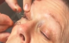 Sjogrens Syndrome / Keratoconjunctivitis Case Study Using AmbioDisk
