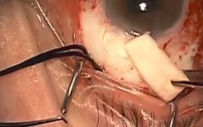 Tutoplast Clear Cornea Placement